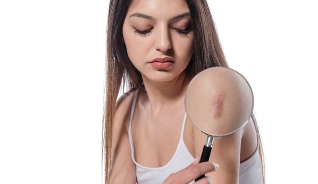 8 Tips Ampuh Menghilangkan Keloid yang Menahun