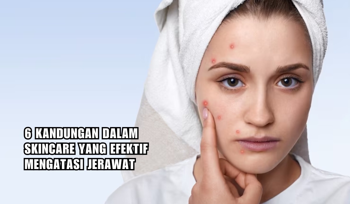 6 Kandungan Skincare yang Ampuh Mengatasi Jerawat, Acne Fighter Wajib Tahu!