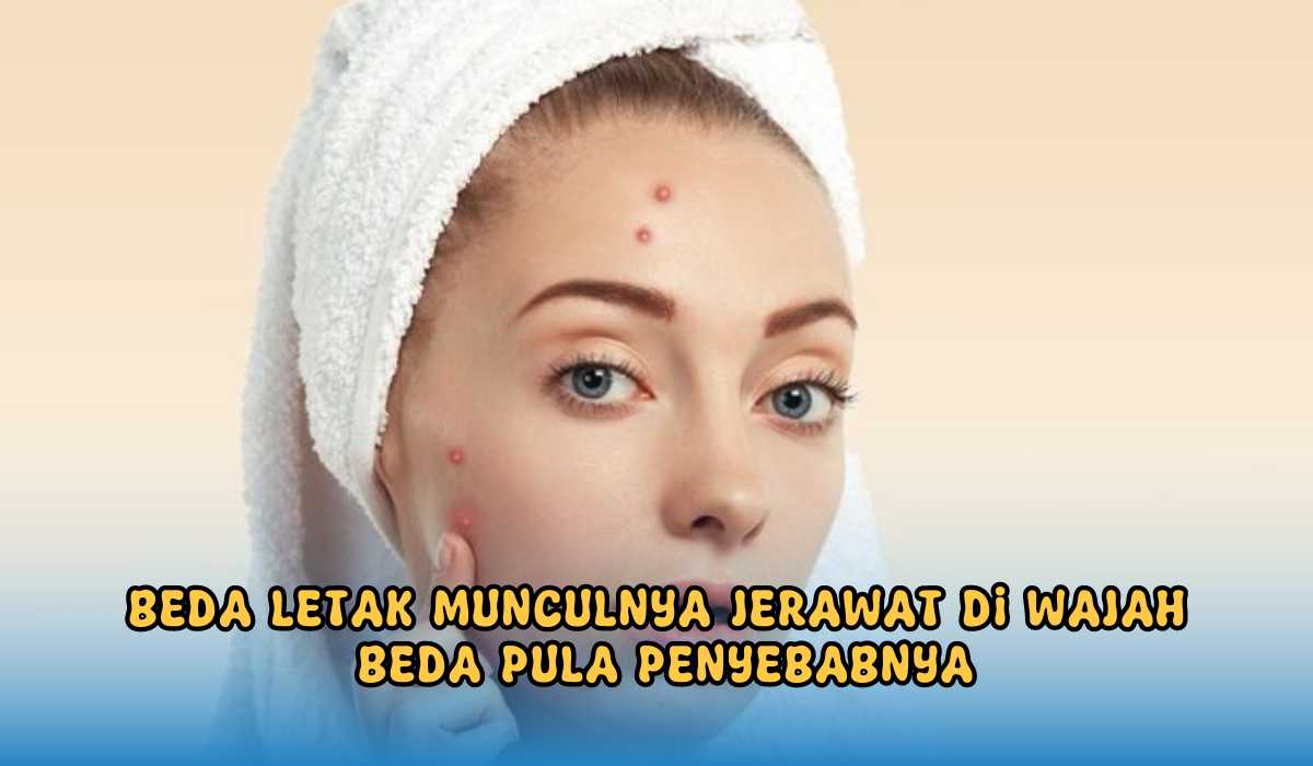 Kadang di Dahi Kadang di Pipi, Ternyata Beda Letak Munculnya Jerawat, Beda Pemicunya, Sudah Tau?