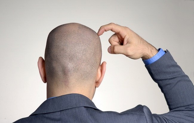 Kepala Botak Lebih Rentan Terkena Penyakit Kulit, Ini Solusinya