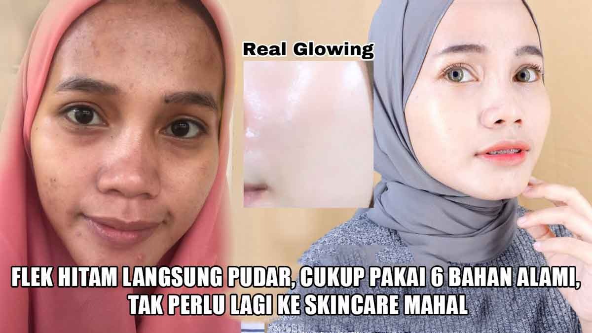 Flek Hitam Langsung Pudar, Cukup Pakai 5 Bahan Alami, Tak Perlu Lagi Pakai Skincare Mahal