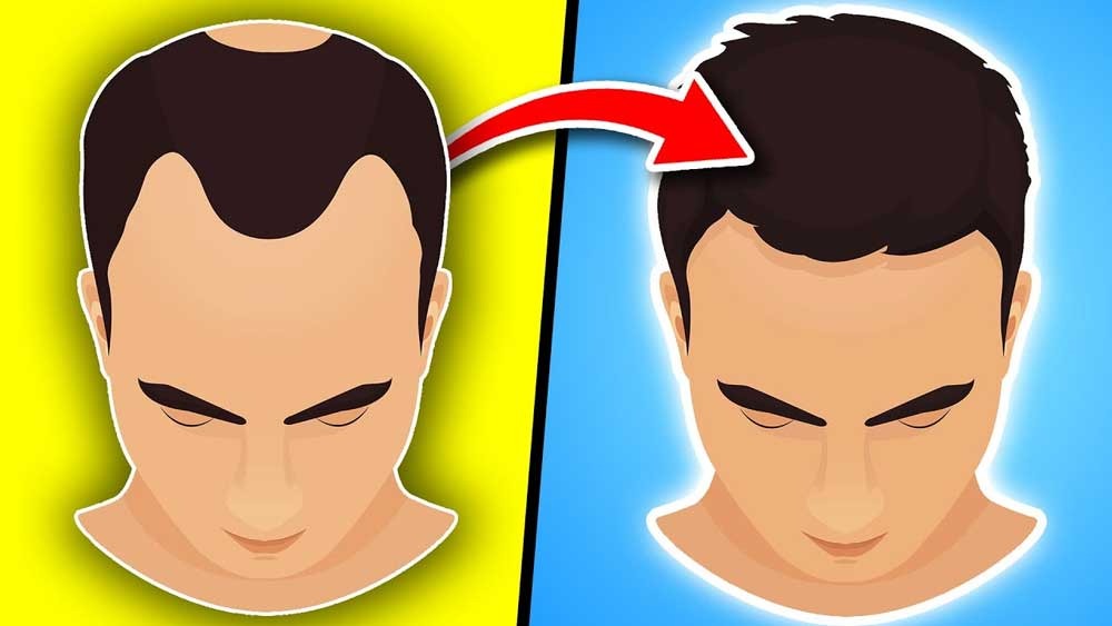 Ini 6 Cara Mudah Menumbuhkan Rambut Botak dengan Cepat, Dijamin Tak Mengecewakan!