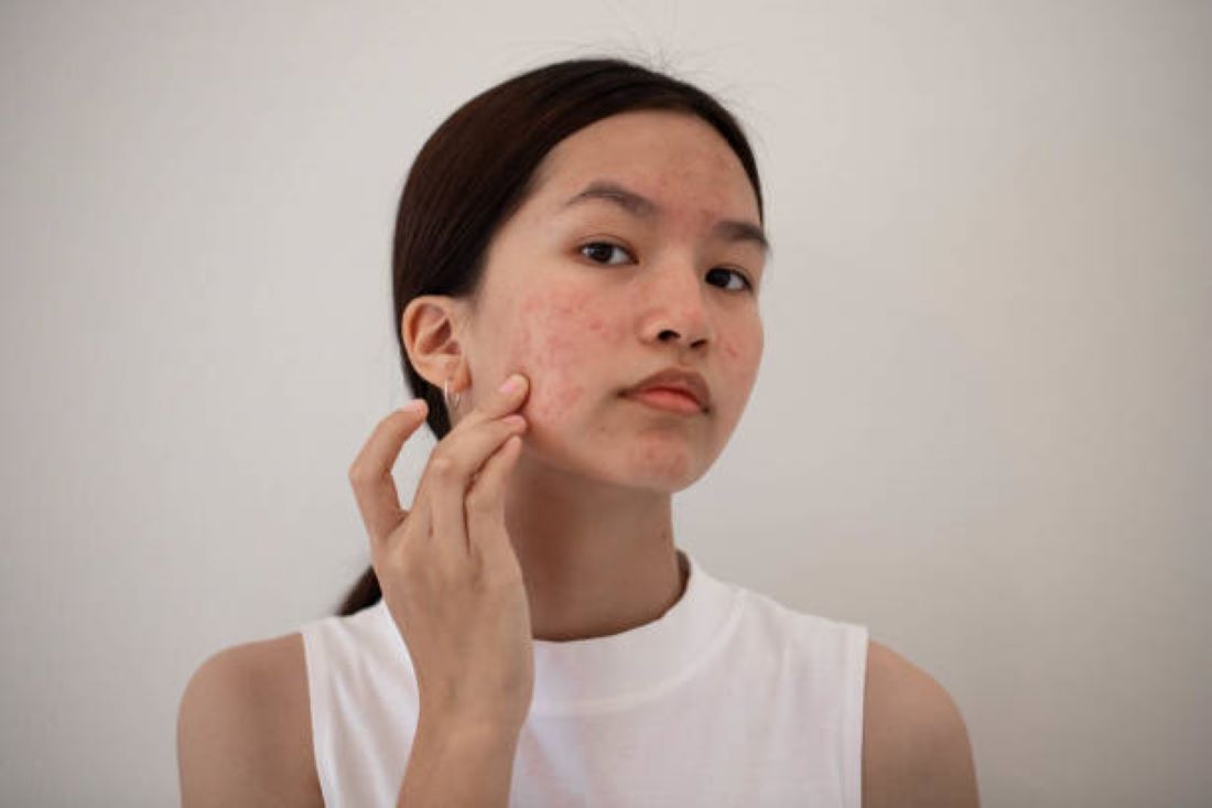 HINDARI! 5 Kebiasaan Ini Bisa Merusak Kulit Sehatmu