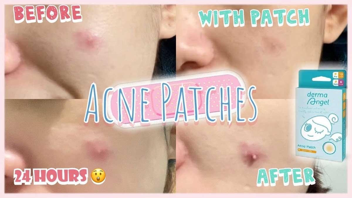 Hempaskan Jerawat dengan Acne Patch Hologram Derma Angel, Tampil Percaya Diri Ala Eca Aura