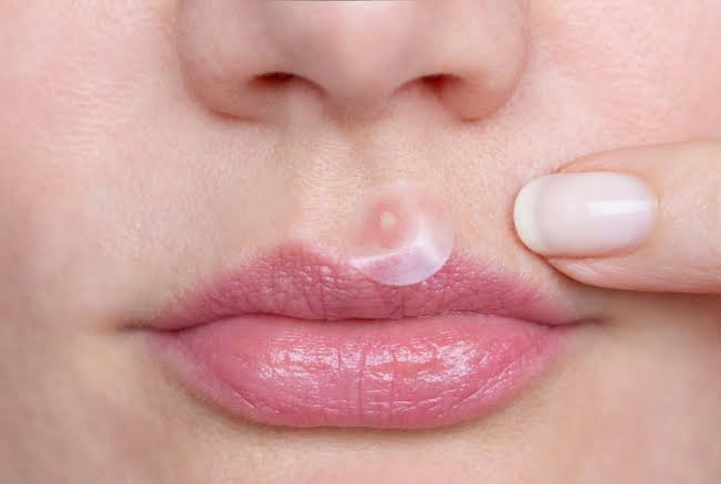 Rekomendasi 7 Produk Acne Patch yang Bagus untuk Hilangkan Jerawat di Wajah