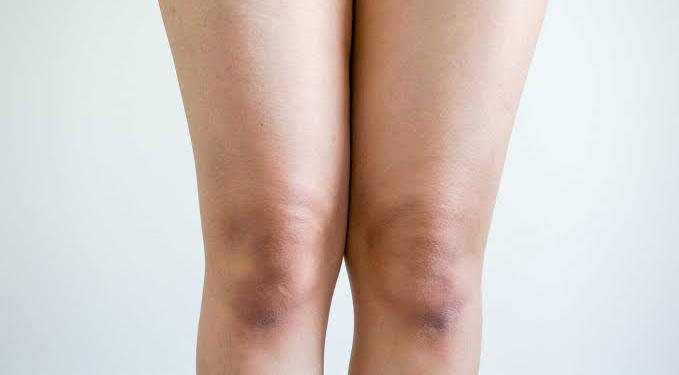 5 Cara Alami yang Bisa Dilakukan di Rumah untuk Mengatasi Lutut Hitam, Cukup 15 Menit
