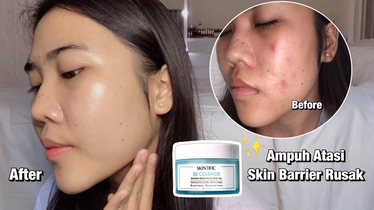 Cara Mengatasi Kulit Sensitif dan Breakout: Moisturizer Andalan Aku!