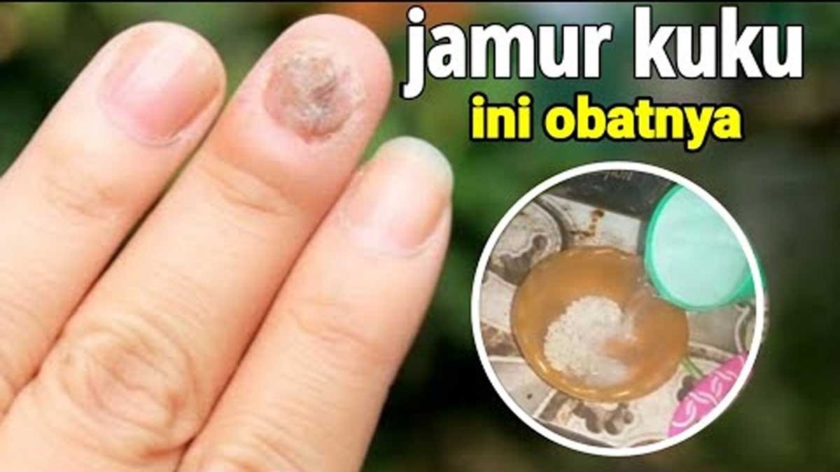 Waspada! Ternyata Ini Lho Gejala Jamur Kuku dan Cara Mencegahnya