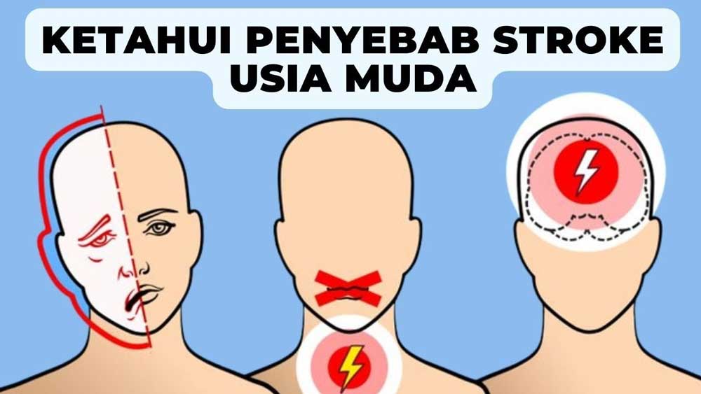 Gen Z Wajib Tahu! Ini 4 Tanda dan Penyebab Stroke di Usia Muda