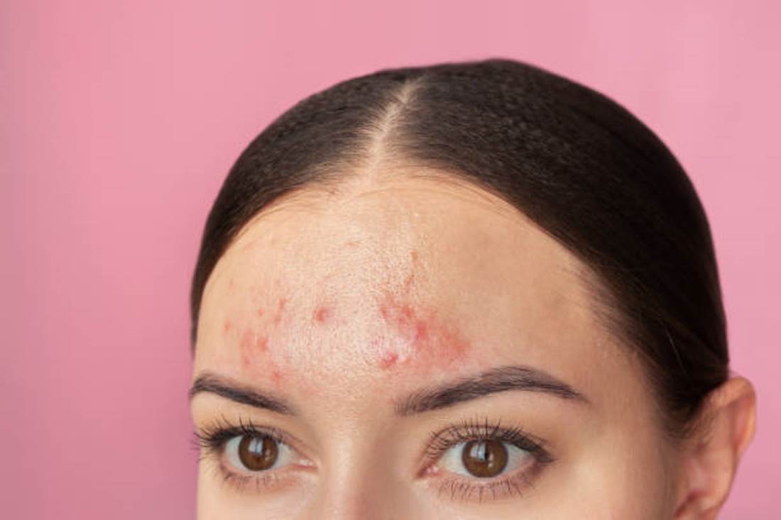 Jerawat di Dahi dan Cara Mudah Menghilangkannya