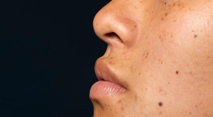 Punya Dark Spot? Cukup Pakai 8 Brand Skincare Ini yang Ampuh Menghilangkan Noda Hitam