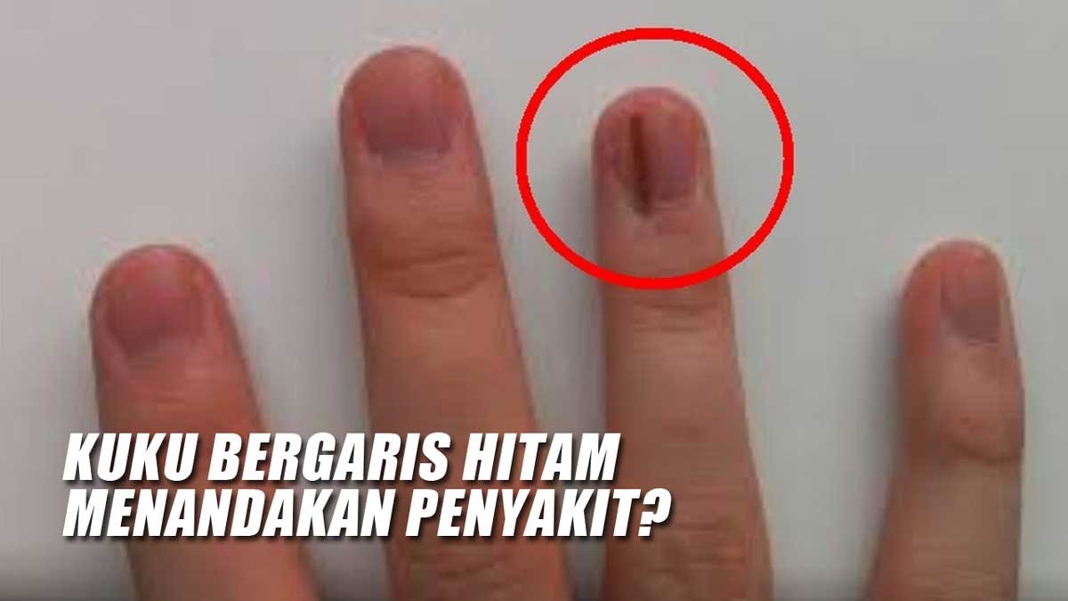 Tahukah Kamu? Kuku Bergaris Hitam Ternyata Menandakan Penyakit Ini!