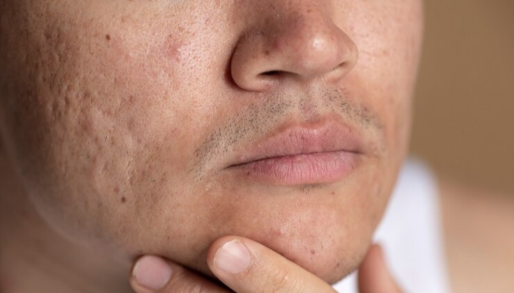 Bye-bye Bopeng! 5 Merk Skincare Serum Lokal yang Bagus untuk Menghilangkan Bekas Jerawat di Wajah