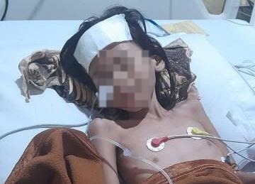 Sungguh Miris, Anak Usia 7 Tahun Sudah 3 Kali Operasi Tak Kunjung Sembuh, Begini Kondisinya di RSMH  