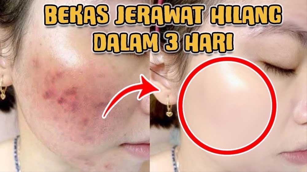 Mengatasi Jerawat Bisa Pakai Madu, Berikut 6 Manfaat Masker Madu dan Cara Pakainya