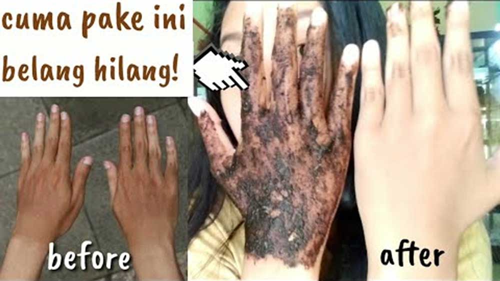 Punya Tangan Belang? Begini 8 Cara Mengatasi Kulit Belang dengan Menggunakan Bahan Alami