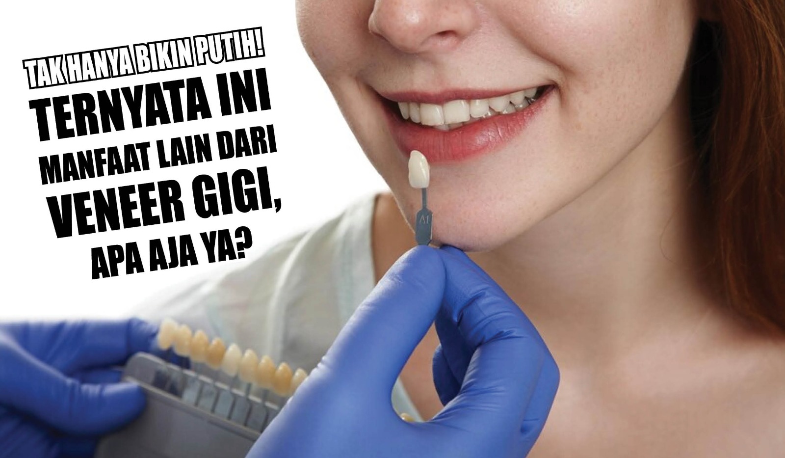 Tak Hanya Bikin Putih! Ternyata Ini Manfaat Lain dari Veneer Gigi, Apa Aja Ya?