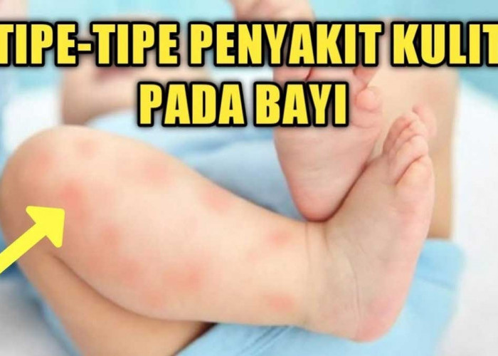 5 Masalah Kulit pada Bayi Baru Lahir, Para Ibu Wajib Waspada