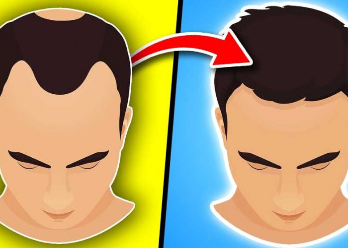 Ini 6 Cara Mudah Menumbuhkan Rambut Botak dengan Cepat, Dijamin Tak Mengecewakan!