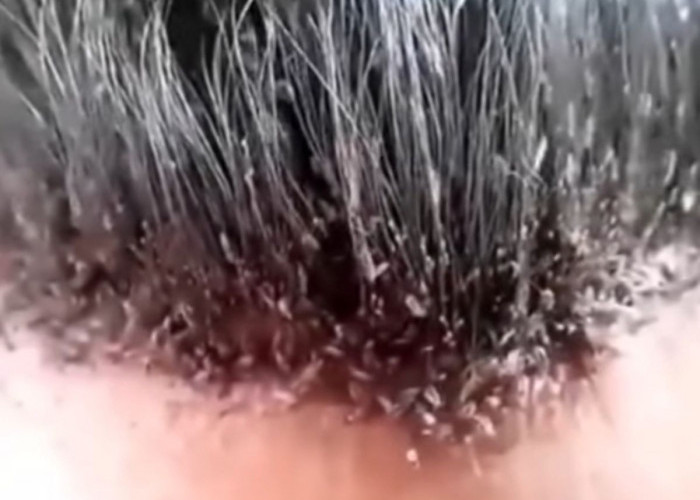 3 Cara Alami Membasmi Serangan Kutu Rambut di Kepala, Berikut Bahan dan Cara Penggunaanya 