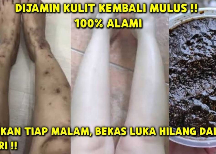 Bekas Koreng Langsung Hilang Seketika, Cukup Gunakan Cara Ampuh Ini, Dijamin Kulit Kembali Mulus