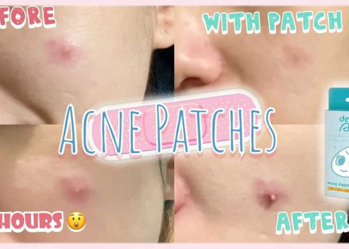 Hempaskan Jerawat dengan Acne Patch Hologram Derma Angel, Tampil Percaya Diri Ala Eca Aura