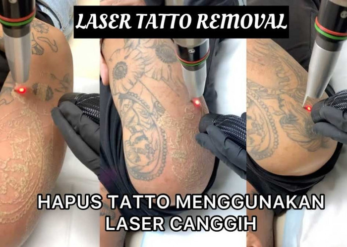 Ingin Menghilangkan Tato di Tubuh, Gunakan Metode Laser, Aman Cepat dan Efektif 