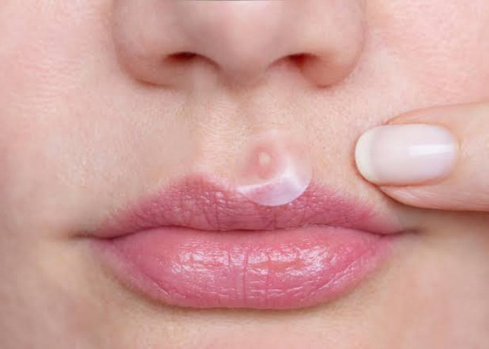 Rekomendasi 7 Produk Acne Patch yang Bagus untuk Hilangkan Jerawat di Wajah