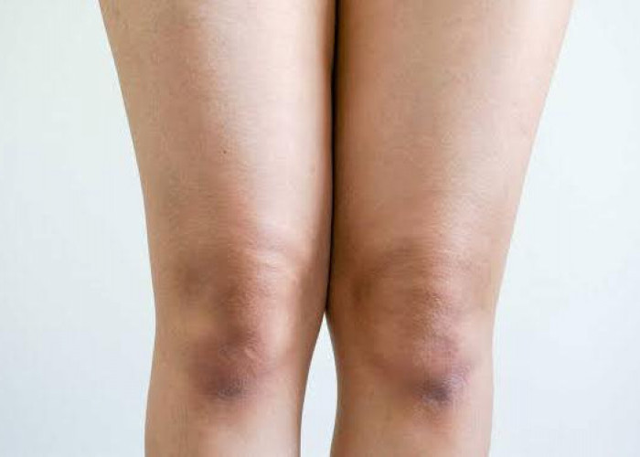 5 Cara Alami yang Bisa Dilakukan di Rumah untuk Mengatasi Lutut Hitam, Cukup 15 Menit