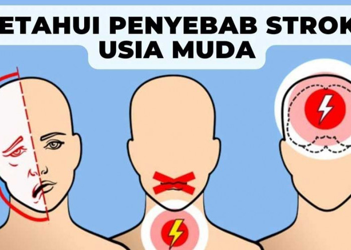 Gen Z Wajib Tahu! Ini 4 Tanda dan Penyebab Stroke di Usia Muda