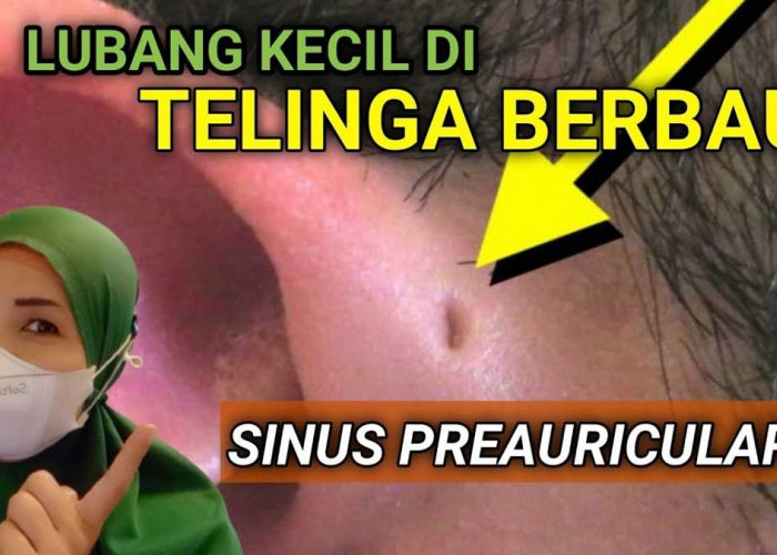 Sinus Preauricular, Lubang Kecil di Dekat Telinga, Ternyata Baunya Gak Enak Loh