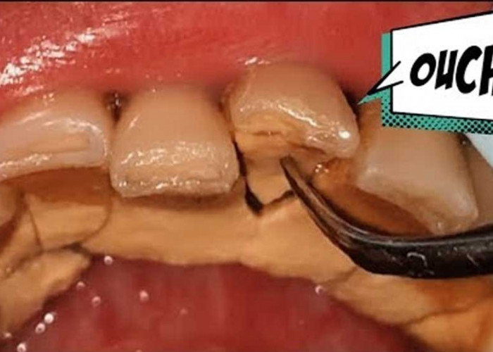 5 Cara Mudah Menghilangkan Karang Gigi, Wajib Kamu Ketahui