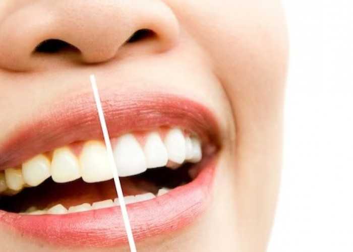 Apakah Bleaching Gigi Boleh Dilakukan? Intip Penjelasannya di Sini!