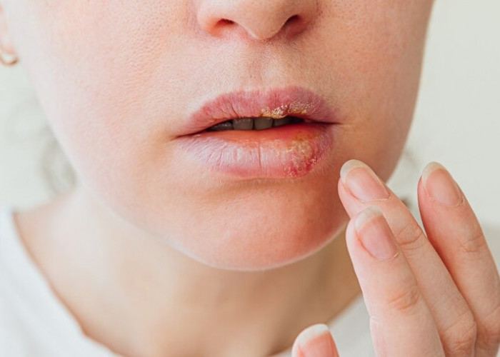 Punya Keluhan Bibir Kering saat Hamil? Atasi dengan Cara Ini 