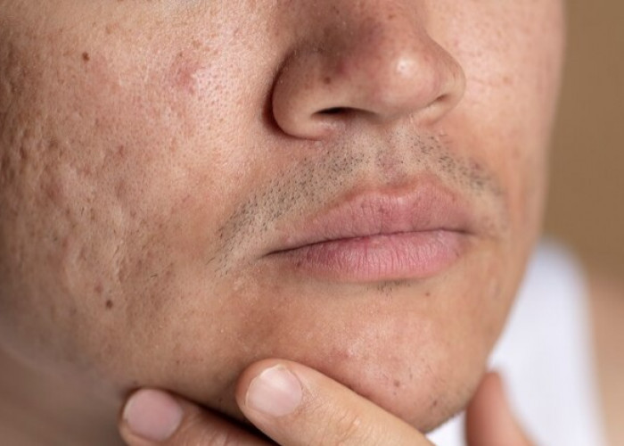 Bye-bye Bopeng! 5 Merk Skincare Serum Lokal yang Bagus untuk Menghilangkan Bekas Jerawat di Wajah