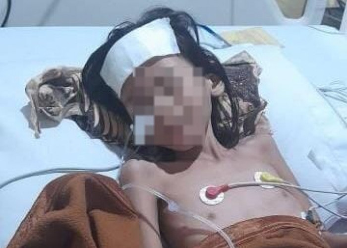 Sungguh Miris, Anak Usia 7 Tahun Sudah 3 Kali Operasi Tak Kunjung Sembuh, Begini Kondisinya di RSMH  