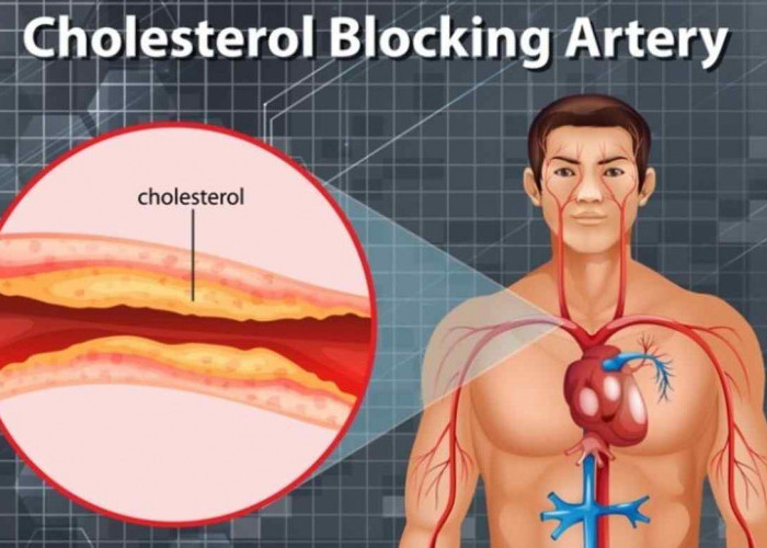 Hati-hati! Kolesterol Tinggi Bisa Sebabkan Serangan Jantung atau Stroke, Ini Penjelasannya