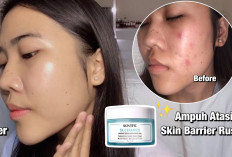 Cara Mengatasi Kulit Sensitif dan Breakout: Moisturizer Andalan Aku!